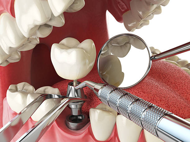 Best Broken or Cracked Tooth Emergency Dentist in Duncannon, PA